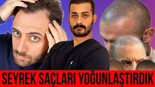 YOĞUN SAÇ ELDE ETMEK  (saç ekimi sonrası saç simulasyonu diyarbakır)