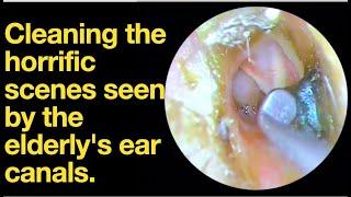 Cleaning the horrific scenes seen by the elderly's ear canals.|ear wax removal | ear cleaning | ASMR