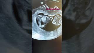 Bleeding in Pregnancies | Dr. Silpahasa Samalla || Best gynaecologist