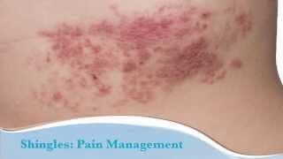 How to treat shingles