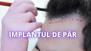 Procedura de implant de par | DermaBeauty Clinique