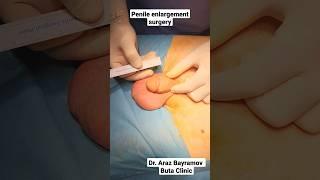 Penile enlargement surgery Penis surgery Dr Araz Bayramov penilenlargement.com #penis #penilsurgery