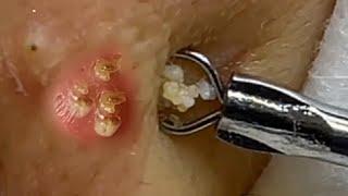 Big Cystic Acne Blackheads Extraction Blackheads & Milia, Whiteheads Removal Pimple Popping #070