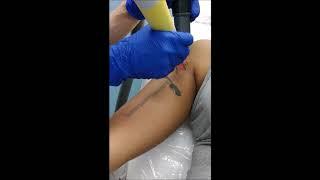 Laser Tattoo Removal at Skin Deep, Northern Virginia, Alexandria, Fairfax, Burke