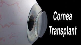 Cornea Transplant (Penetrating Keratoplasty)