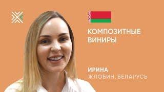 Композитные виниры: отзыв пациента клиники KANO (Минск)