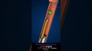 How Doctors Remove Kidney Stones Without Surgery! (Lithotripsy demonstrated)