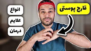 انواع قارچ پوستی | درمان | علت | تشخیص | علایم