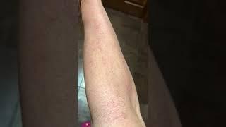 Day 3 post Sciton Halo laser resurfacing arms Cleveland Ohio