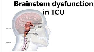 Brainstem dysfunction in ICU