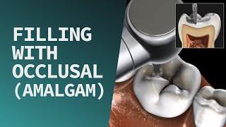 Filling with Occlusal (Amalgam)