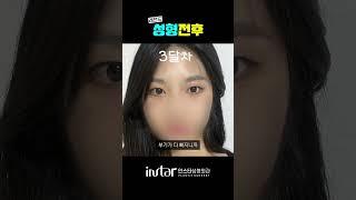 무쌍 유지하면서 눈만 커지는 신박한 성형수술 #무쌍 #무쌍눈매교정 #눈매교정 #성형전후 #눈성형 #눈성형잘하는곳 #인스타성형외과