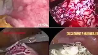 Laparoscopic Myomectomy | Laparoscopy | Dr. Sushmita Mukherjee