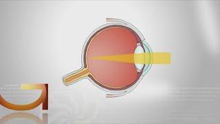 Why Are More People Developing Nearsightedness?