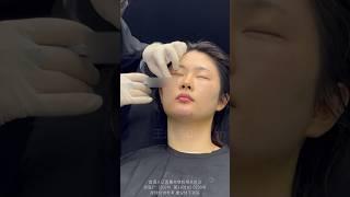 别眨眼，20秒带你看微调的魅力#医美 #微整 #antiaging #无痛美容 #injectables #午休式变美 #filler #逆龄 #注射