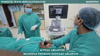 Multiple Thyroid Nodules Ablation by Dr. Sandeep Sharma | IRFACILITIES