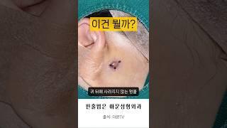 귀뒤 멍울? (뾰루지 피지 압출 핀홀법 피지낭종 표피낭종 수술 여드름 병원 epidermal cyst pimple surgery hospital seoul korea)[아문TV]