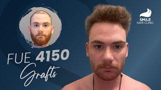 4150 Grafts Hair Transplant: 12-Month Before & After Transformation | Smile Hair Clinic