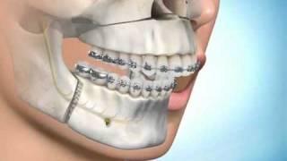 ‪Surgical Correction of Long Face Syndrome‬‏.