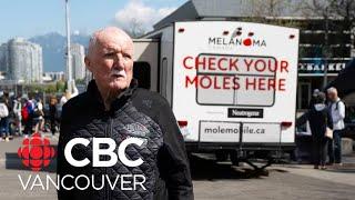 Mole mobiles aim to speed up skin cancer screenings as Canada struggles with dermatologist shortage