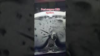 CBD Ligation post surgery