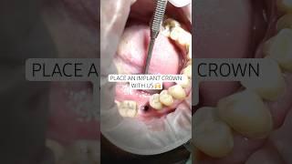 How it’s done: Placing an implant crown  #newsmile #dentalimplant #implant #compositeveneer