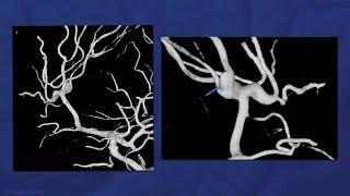 Clip Reconstruction of Syndromic Azygos Anterior Cerebellar Aneurysm