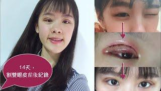 割雙眼皮分享 | Double Eyelid Surgery