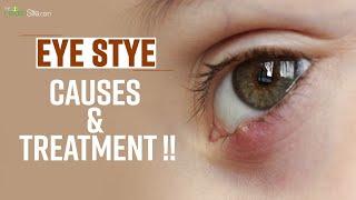 Eye Stye |Causes |Treatment | Symptoms || The Health Site