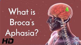 Broca's Aphasia and the Brain: What We Know and What We're Still Learning