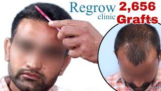 Best Hair Transplant Result 2021 || NW Grade III || 2,656 Grafts ||  @Regrow Clinic ​