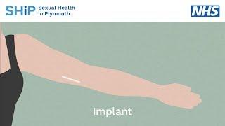 Having a contraceptive implant fitted