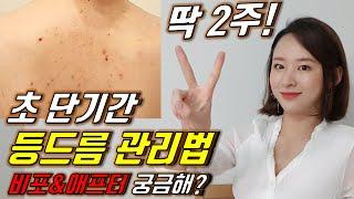 등드름 없애는 법 딱 2주만에! 흉터 관리, 가드름 짜기 (비포애프터 있음) | 뷰티트레이닝 주강