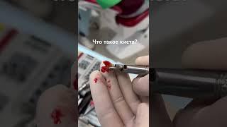 Киста ? Удалили зуб с кистой #шортс #москва #зубы #удалениезубовмудрости