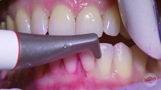 How teeth should be cleaned at the Dentist / Hygienist