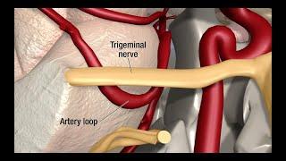 Treatment for Trigeminal Neuralgia: UCSF Neurosurgery