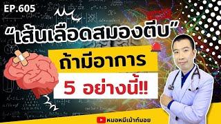 มีอาการ 5 อย่างนี้ เส้นเลือดในสมองตีบแน่นอน | เม้าท์กับหมอหมี EP.605