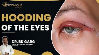 Hooded Eyelids Treatment | Hooded Eyelid Fix | Hooded Eyelids Exercise | Hooded Eyes Treatment