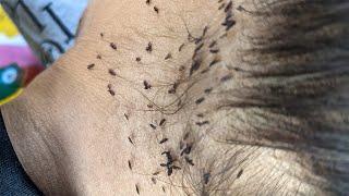 Taking out all head lice from her hair - Remove hundred head lice out