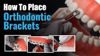 How to place Orthodontic Brackets | Step-by-Step Guide for Dentists 