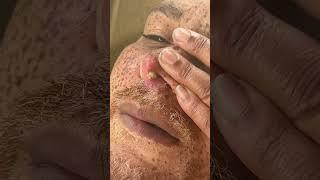 ****NEW**** 2023******CYSTIC ACNE REMOVAL