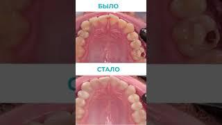 Лечение кариеса под микроскопом. Клинический случай. Стоматология в Самаре