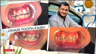 Smile Revival:The Journey with Dental Braces#dental#smile #umair toothfairy@Umairazeem8553