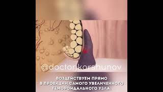 Лазер при геморрое