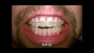 Anterior Open Bite Correction