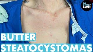 Dr Pimple Popper Mines For Butter Steatocystoma! 