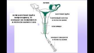 Проверка маточных труб. УЗИ ГСС / Как было у меня