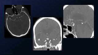 Clipping of Anterior Communicating Artery and Middle Cerebral Artery Aneurysms