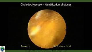 Percutaneous electrohydraulic lithotripsy in the effective management of choledocholithiasis for...