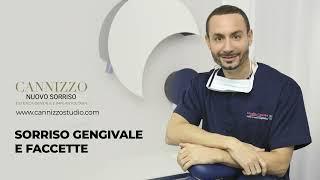 Faccette in Ceramica e Correzione Sorriso Gengivale - Studio Cannizzo